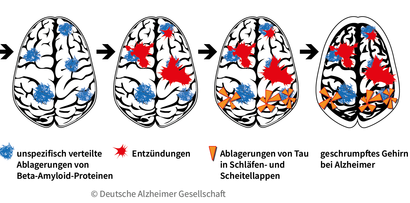 Darstellung der Krankheitskaskade im Gehirn