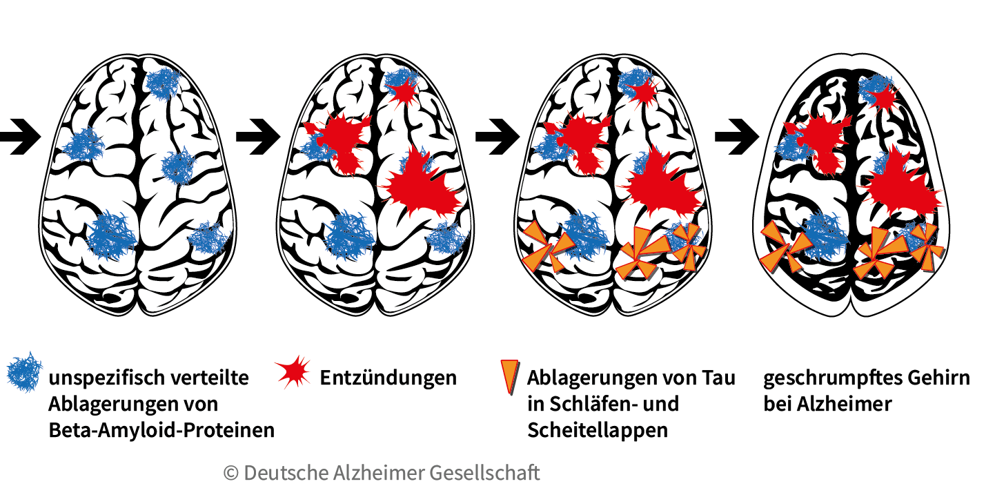 Darstellung der Krankheitskaskade im Gehirn